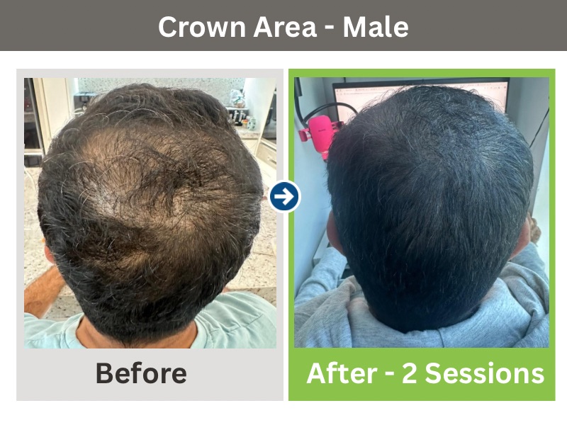 Growth Phase Anagen (1)